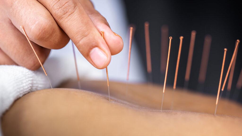 Acupuncture
